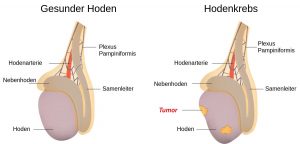 Diagnose Hodenkrebs: Was bedeutet das? 4