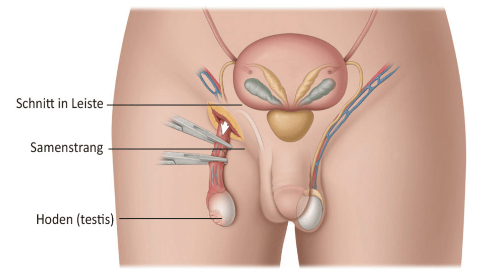 Orchiektomie-Operation