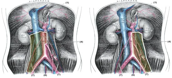 Operationsgebiet bei einer rechtsseitigen und linksseitigen retroperitonealen Lymphadenektomie