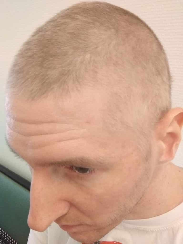 Wann fallen Haare bei der PEBChemo aus? Erfahrungsbericht